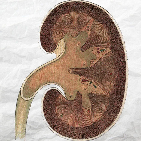 Rapidly Progressive Renal Failure Treatment in Vijayawada