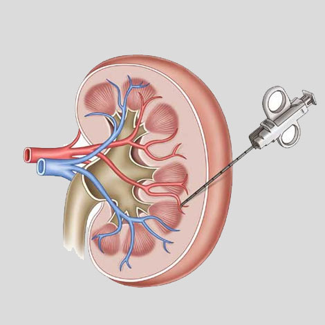 Renal Biopsy treatment in Vijayawada